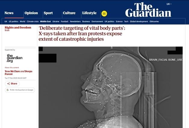 "머리에 2~5mm 산탄 수십 개"…참혹한 이란 시위자 X레이