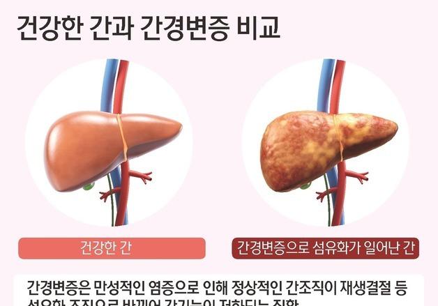 "70% 망가져도 모른다"…간경변증이 보내는 경고