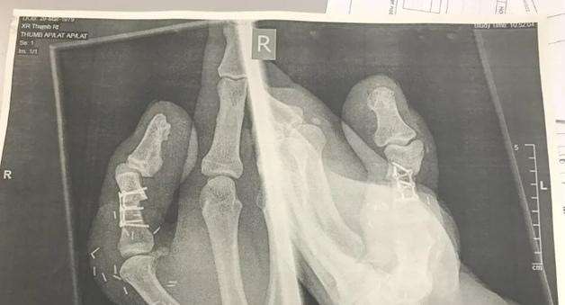 손가락 절단 당하자 발가락 붙인 구두 수선공…"일 하려고"