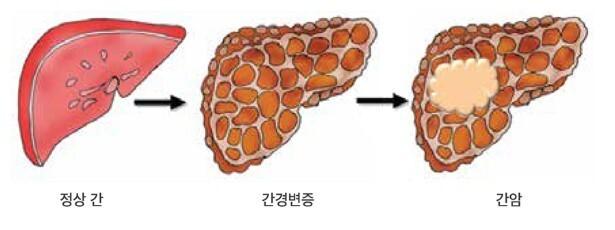 "병든 간에 잘 생겨"…연 2회 2개 검사로 간암 예방