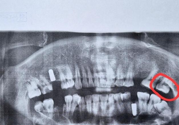 "치과서 다른 치아  잘못 깎아 발치 위기"…인지 기능 장애 환자의 호소