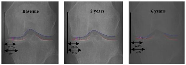 "AI로 무릎 골관절염 최대 마모 지점 정밀하게 찾아낼 수 있다"