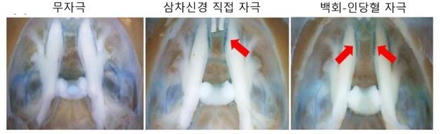 "침 치료로 PTSD 우울·불안 개선 효과 확인"