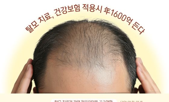 [오늘의 그래픽] 탈모 치료, 건강보험 적용시 年1600억 든다