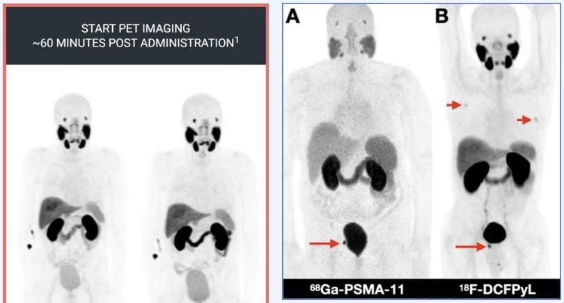 본문 이미지 - 전립선암 진단용 차세대 방사성의약품 '프로스타시크' 활용 모습.(듀켐바이오 제공)/뉴스1