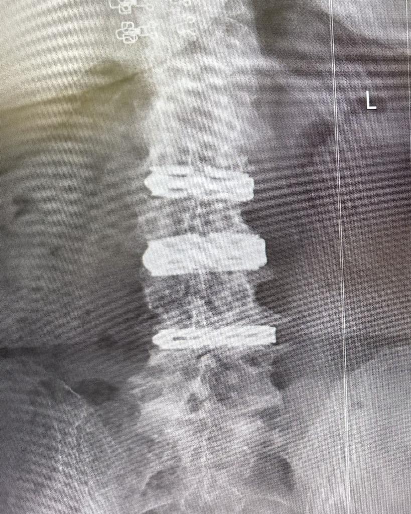 본문 이미지 - 환자의 수술 후 전후방 X-ray 이미지. (엘앤케이바이오메드 제공)